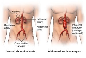 Abdominal Aortic Aneurysm - Freedmans Health