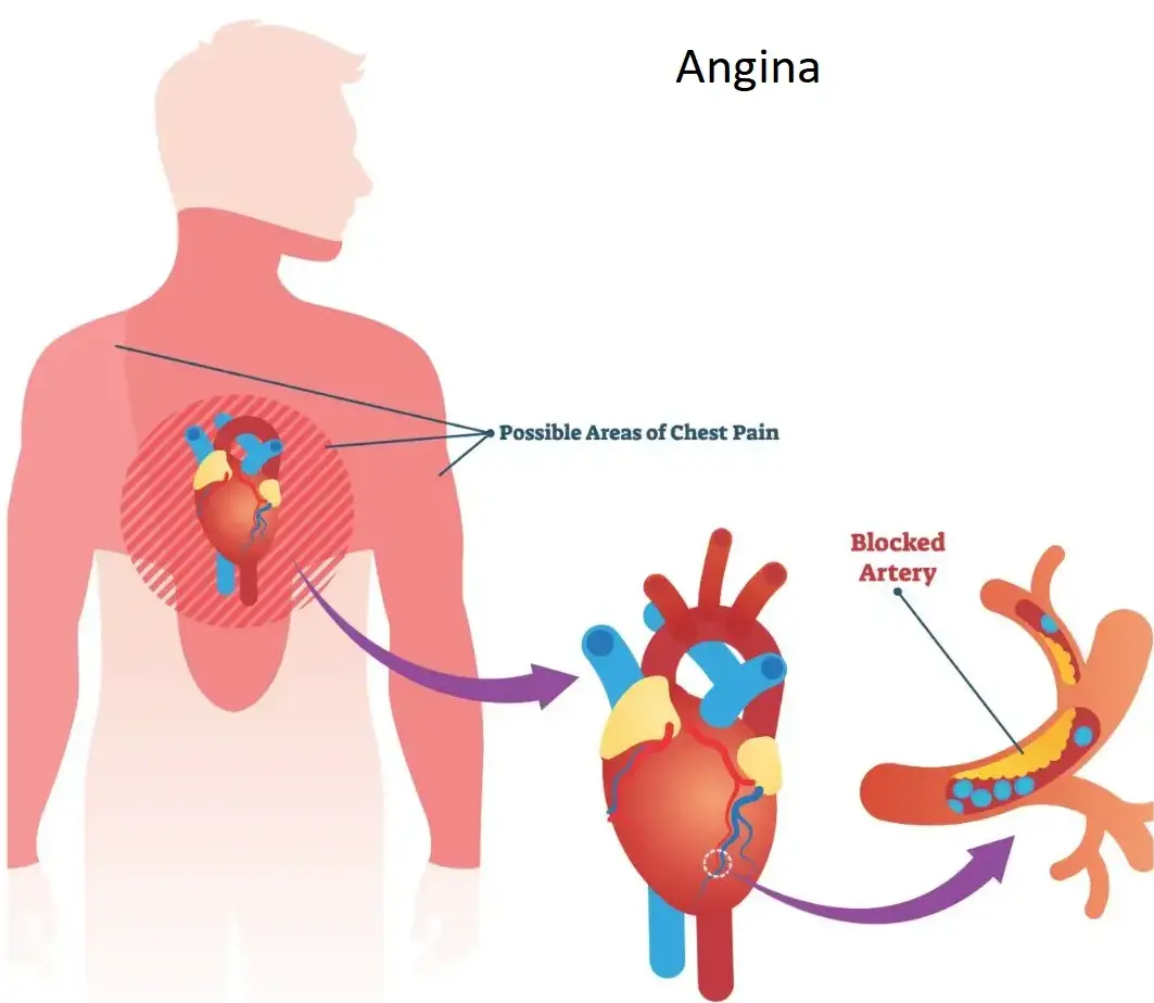 Angina