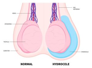 Hydrocele - Freedmans Health