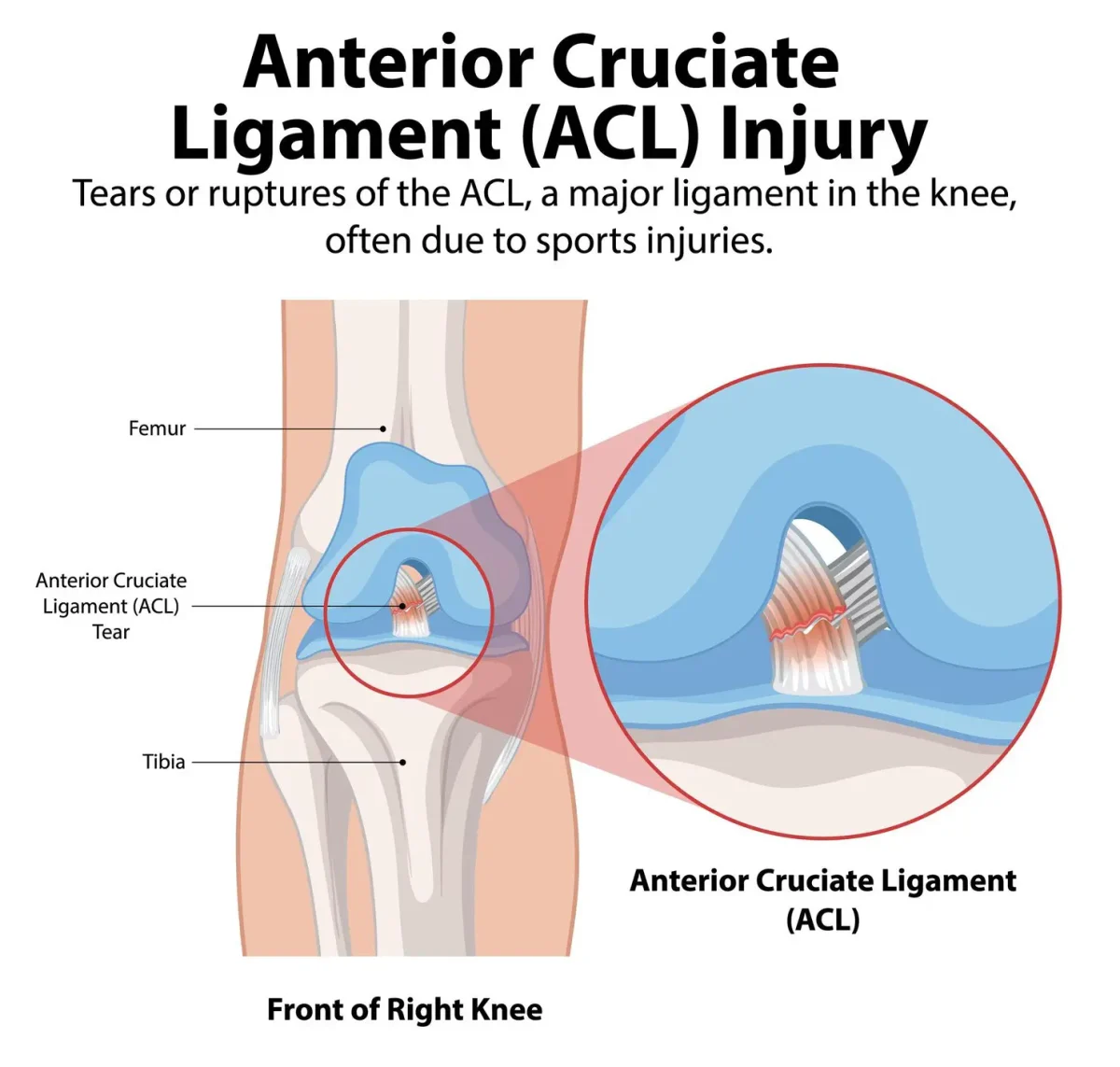 acl-injury-knee-anatomy